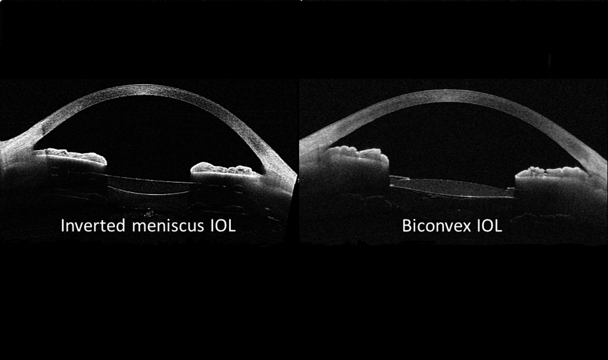 La UMU desarrolla las primeras lentes intraoculares para ver a todas las distancias sin destellos y con visión periférica mejorada
